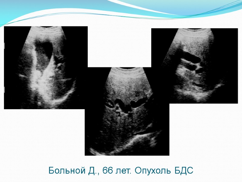 Больной Д., 66 лет. Опухоль БДС